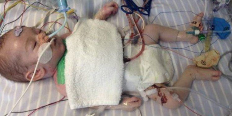 Beba s pola srca preživjela moždani udar, 9 operacija, 3 oživljavanja i ne predaje se!