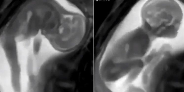 Neodoljiva snimka bebe koja se razgibava u maternici, koja otkriva kako mališani provode vrijeme u trbuhu